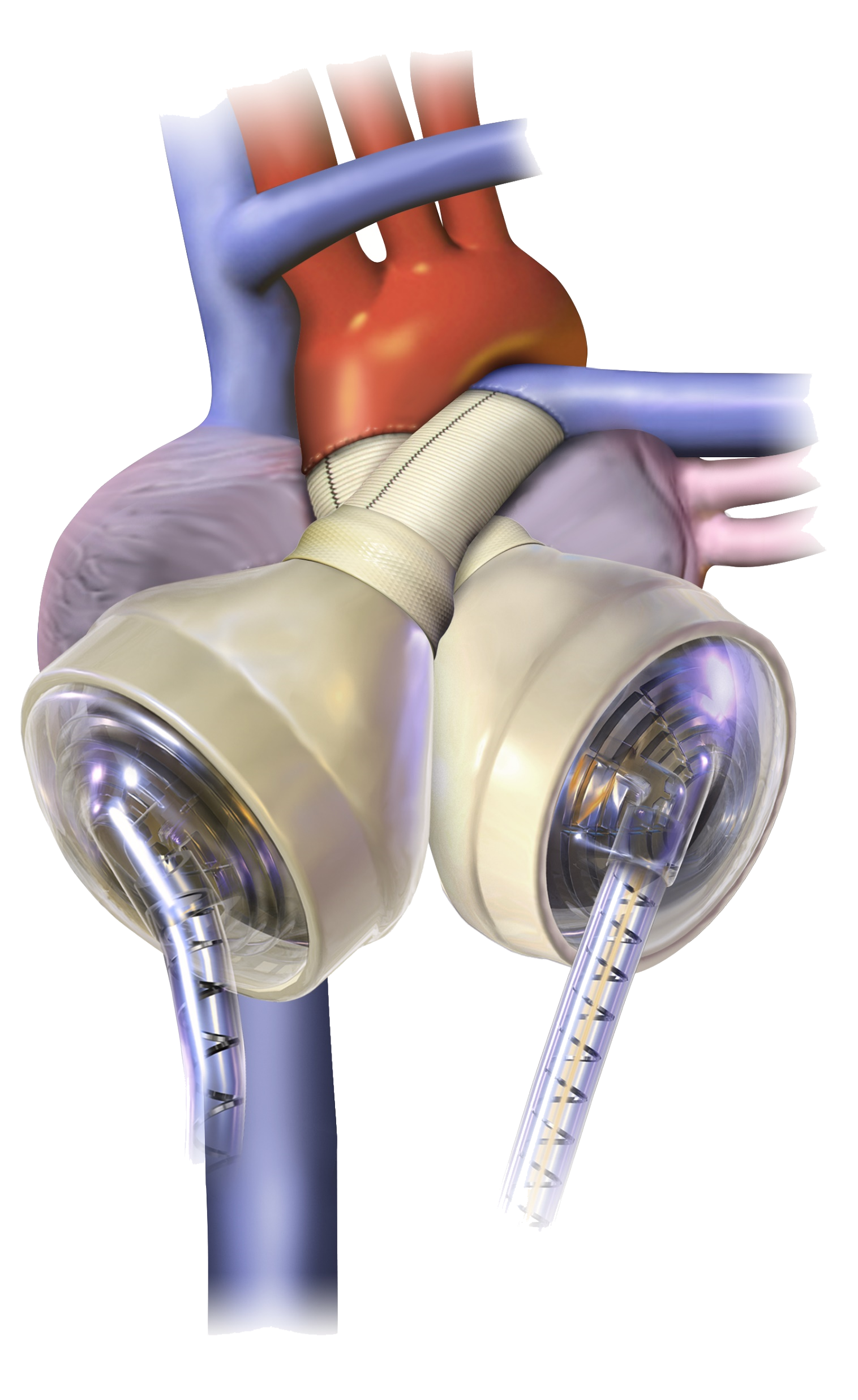 Clinical illustration of an implanted SynCardia Total Artificial Heart, showing the great vessels connecting to the two artificial ventricular chambers via the sewn cuff, with the two drivelines exiting below.